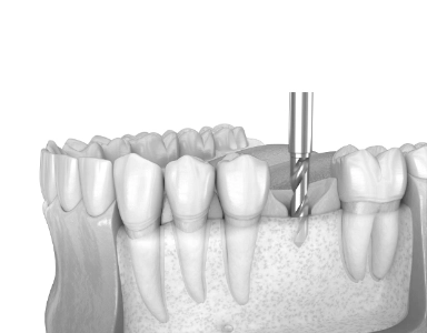 Implantology Course 1